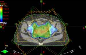 An example of a 3D intensity modulated radiotherapy IMRT dose plan created for a