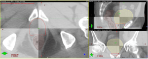 CBCT