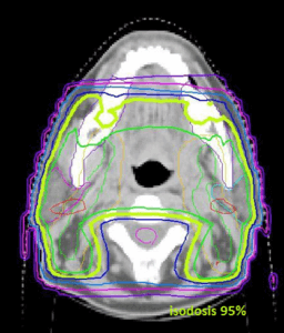 Curvas de isodosis