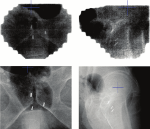 Example of anteroposterior and lateral electronic portal imaging above and kilovoltage