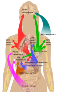 Metastasis